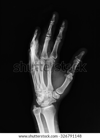 Human hand x-ray - Medical Image.