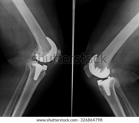 Knee with total replacement x-ray image on black background.