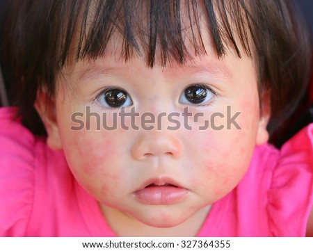 face baby rash, dermatitis