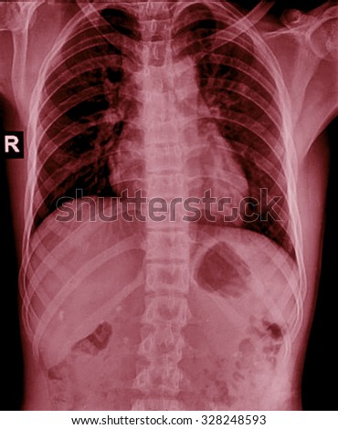 X-Ray Image Of humen Chest for a medical diagnosis