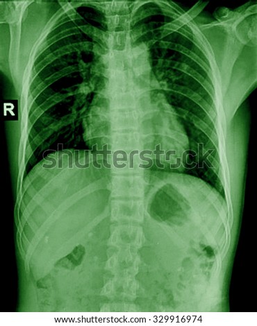 X-Ray Image Of humen Chest for a medical diagnosis