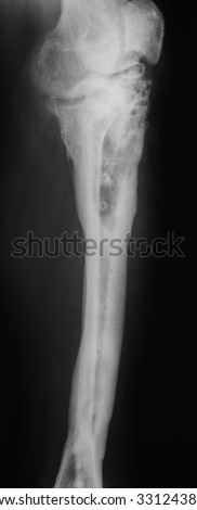 X-ray image of knee include leg showing bone infection. Royalty-Free Stock Photo #331243802