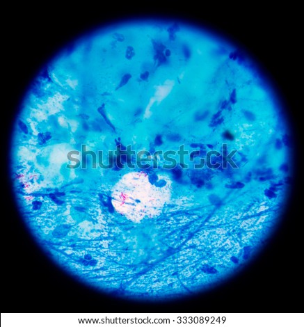 Bacterial infection tuberculosis.red cells in blue background.AFB 2+