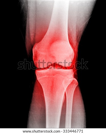 X-ray of human knee bone joint
