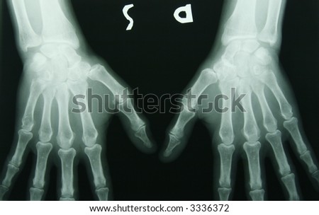 x-ray photo of person's hands