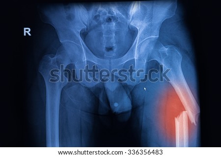 X-ray image of both hip showing femur fracture at left side Royalty-Free Stock Photo #336356483