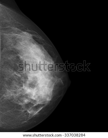 X-ray image of Breast or Mammogram woman.