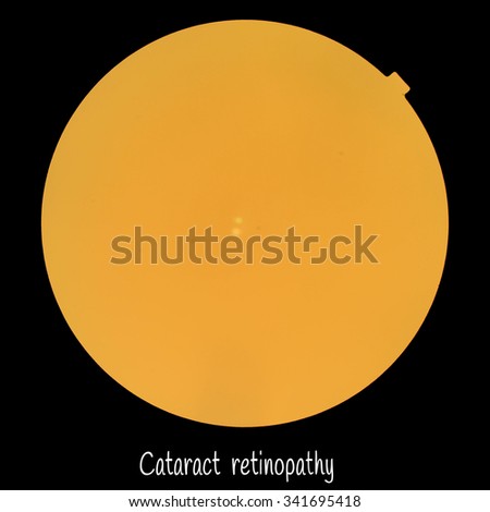 Medical photo retinopathy of Cataract (eye screen) (It seems that the picture is not clear or out  focus because corneal clouding)