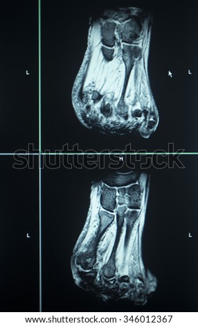 MRI magentic resonance imaging nuclear scanning scan test results foot toes injury photo.