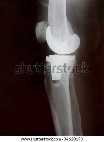 Total knee replacement x-ray side picture in natural colors