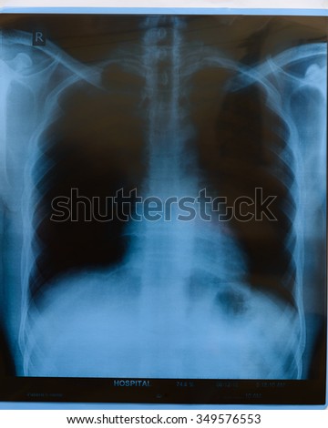 X-Ray Image of a Human Chest/TB screening/roentgen image, it is taken to examine the lungs, chest and heart. This result shows a normal human's chest. Medical and healthcare background