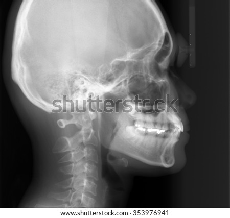 Picture head x-rays
