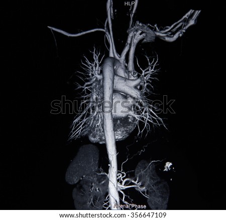 Film x-ray Ct angiogram 3D take photo from Film