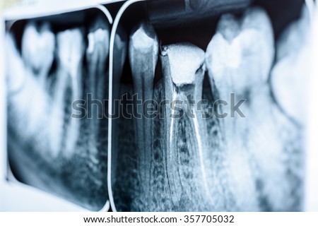 Obturation of Root Canal Systems On Teeth X-Ray Royalty-Free Stock Photo #357705032