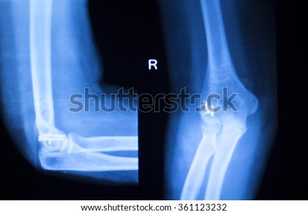 Othopedics and Traumatology surgical implant arm and elbow xray test scan results showing titanium metal plate and screws.