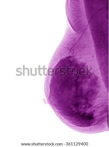Mammogram breasts of a female patient