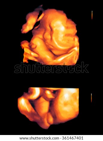 Picture 4D Ultrasound of baby in mother's womb : (Gestational age of 35 weeks / 8 months)
