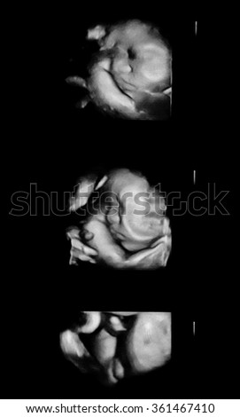 Black and white illustration Picture 4D Ultrasound of baby in mother's womb: (Gestational age of 35 weeks / 8 months).