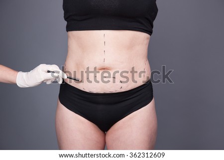 Cosmetic Surgery, Abdominoplasty Female abdomen, Liposuction. Cellulite, streamers, adult Women after Obesity and  Delivery.  Fat Woman, Abdominoplasty. Circular tummy tuck.                