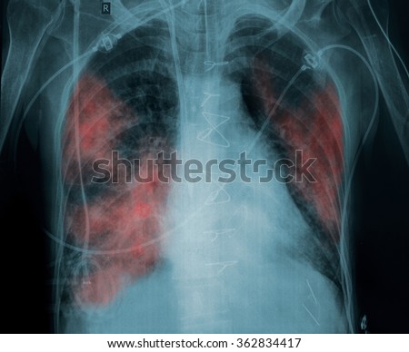 X-ray picture of a patient with lung pathology.