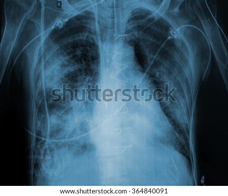 X-ray picture of a patient with lung disease.