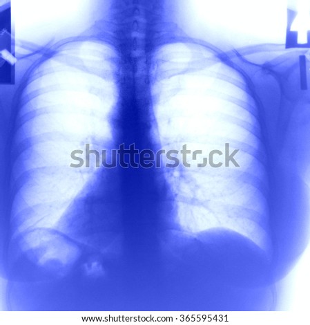 Chest and lungs Xray (X-ray) photo