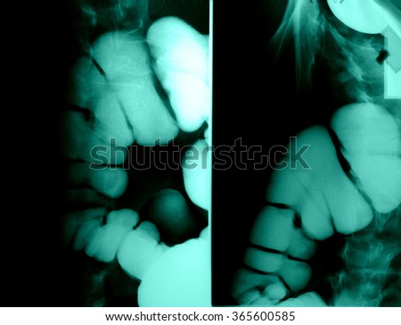 Intestinal Xray (X-ray) photo