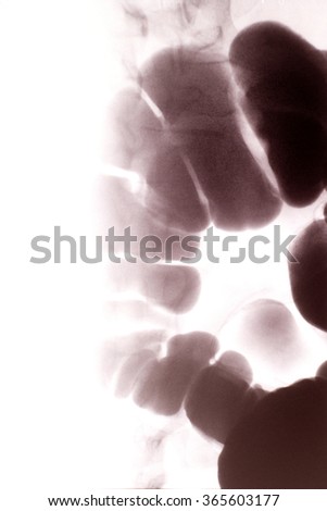 Intestinal Xray (X-ray) photo