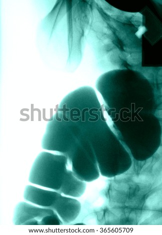 Intestine Xray (X-ray) photo