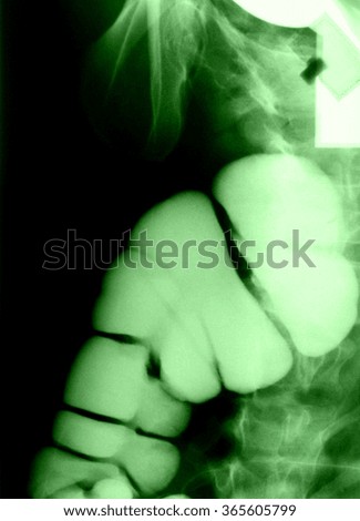 Intestine Xray (X-ray) photo