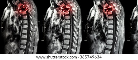 Spine metastasis ( cancer spread to thoracic spine ) ( MRI of cervical and thoracic spine : show thoracic spine metastasis and compress spinal cord ( Myelopathy ) ) ( sagittal plane ) Royalty-Free Stock Photo #365749634