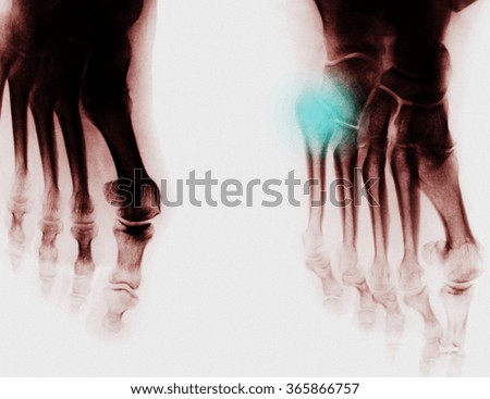 Foot Xray (X-ray) photo