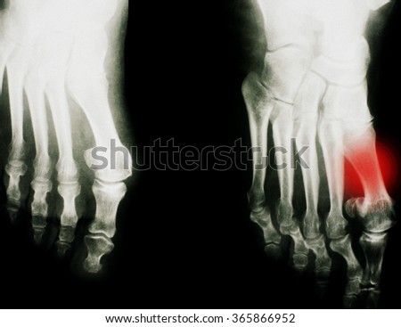 Foot Xray (X-ray) photo