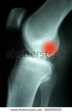 Knee Xray (X-ray) photo