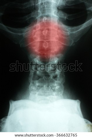 Lumbar Spine Xray photo