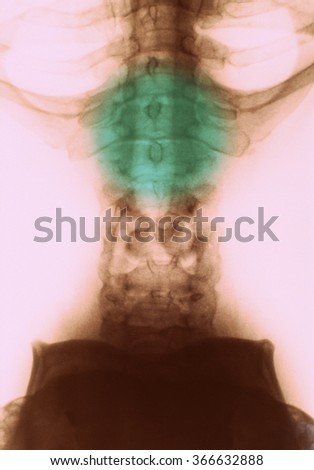 Lumbar Spine Xray photo