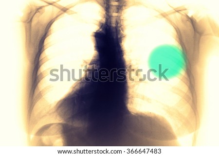 Chest and breast Xray photo