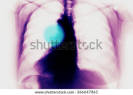 Chest and breast Xray photo