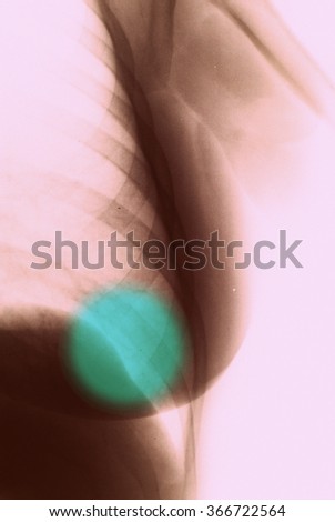 Breast Xray photo
