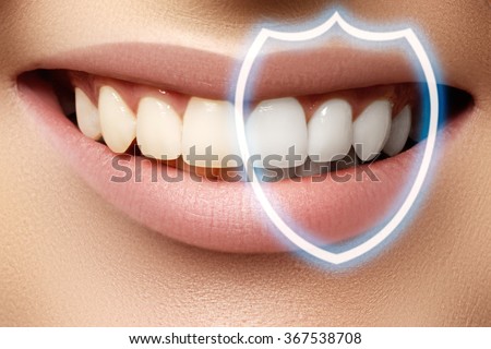 Perfect smile before and after bleaching. Dental care and whitening teeth. Stomatology and beauty care. Woman smiling with great teeth. Cheerful female smile with fresh clear skin

 Royalty-Free Stock Photo #367538708