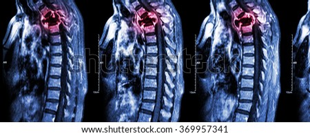 Spine metastasis ( cancer spread to thoracic spine ) ( MRI of cervical and thoracic spine : show thoracic spine metastasis and compress spinal cord ( Myelopathy ) ) ( sagittal plane ) Royalty-Free Stock Photo #369957341