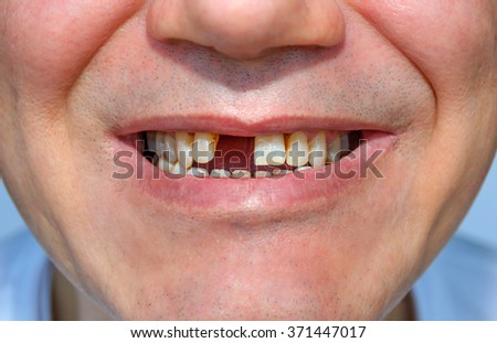 Men's smile without tooth. fragment of face Royalty-Free Stock Photo #371447017