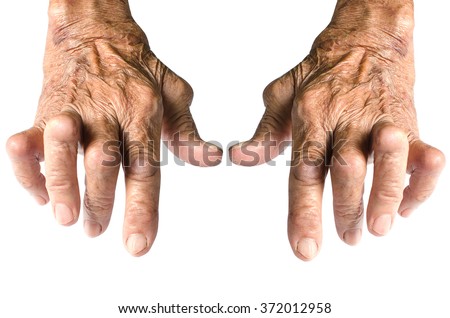 Old Woman's Hands Deformed From Rheumatoid Arthritis Isolated on White Background Royalty-Free Stock Photo #372012958