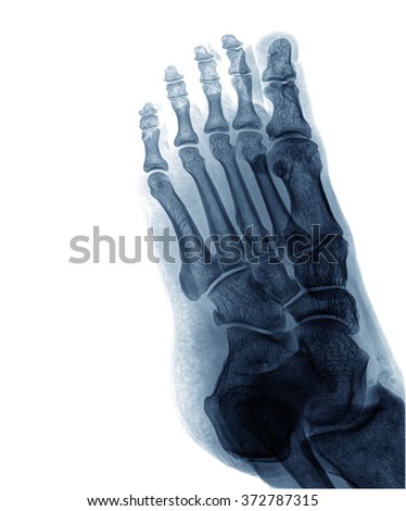 x-ray photo of feet