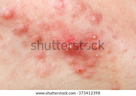 Close up photo of nodular cystic acne skin Royalty-Free Stock Photo #373412398