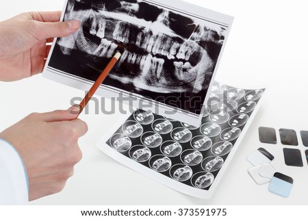 Panoramic x-ray jaw. A dentist holding snapshot the patient's tooth and indicates the problem