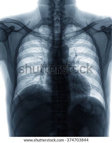 X-Ray Image Of Human Chest for a medical diagnosis