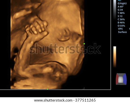 Picture 4D Ultrasound of baby in mother's womb.