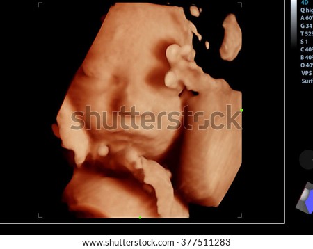 Picture 4D Ultrasound of baby in mother's womb.show the face. Royalty-Free Stock Photo #377511283