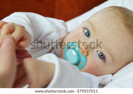 Baby boy suffering from sixth disease (three-day-fever or Roseola). Its manifestations are limited to a transient rash ("exanthem") following a fever. It is a disease of children under two years old. Royalty-Free Stock Photo #379037011